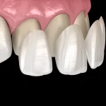 Dental veneer & Laminates