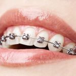 Braces & Aligners