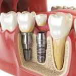 Dental Implant