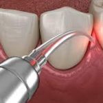 Laser Dentistry